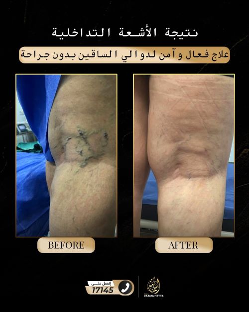 علاج دوالي الساقين عند النساء
